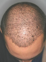NeoGraft Before and After Photo