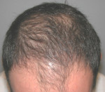 NeoGraft Before and After Photo