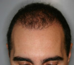 NeoGraft Before and After Photo