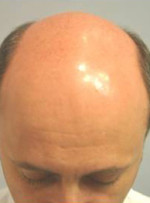 NeoGraft Before and After Photo