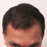 NeoGraft Before and After Photo