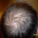 NeoGraft Before and After Photo