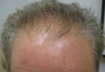 NeoGraft Before and After Photo