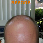 NeoGraft Before and After Photo