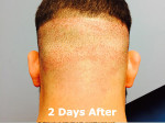 NeoGraft Before and After Photo