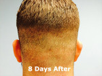 NeoGraft Before and After Photo